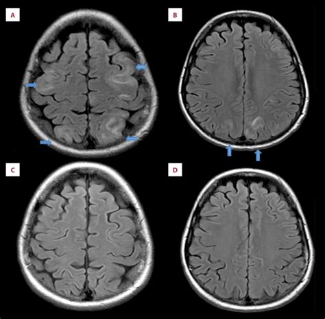 A B Represent Initial Mri Brain Findings Immediate Post Seizure