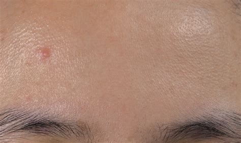 Lumps Bump And Cysts On The Eyebrow What Are They And How To Treat