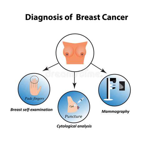 Methods Of Diagnosis Of Breast Cancer Mammography Puncture Breast