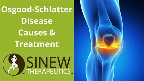 Osgood Schlatter Disease Causes And Treatment Youtube