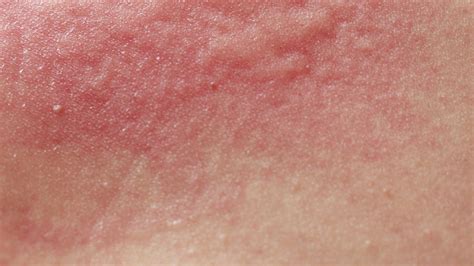 What Is Dermatitis Causes Treatments And Advice For Irritated Skin