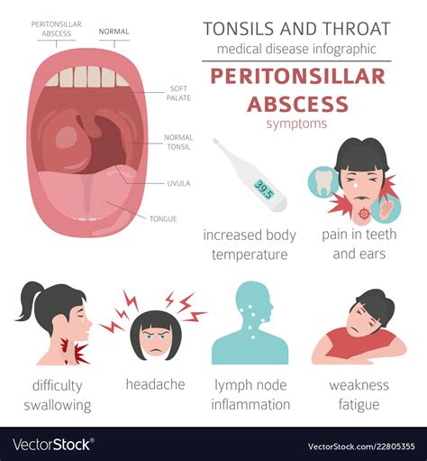 Tonsils And Throat Diseases Peritonsillar Abscess Vector Image