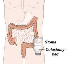 Colorectal cancer might not cause symptoms right away. Colostomy bag patients. Treatment for patients with a ...