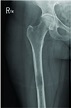 X-Ray right femur, AP view, demonstrates a large lucent | Open-i