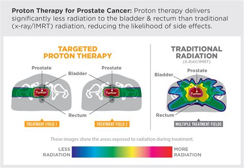 Fight Cancer With Protons Provision Cares Proton Therapy Knoxville