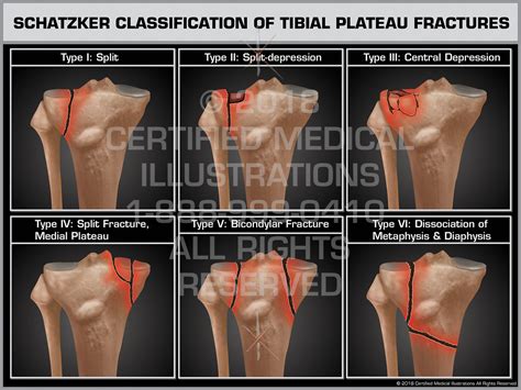 Schatzker Classification Of Tibial Plateau Fractures