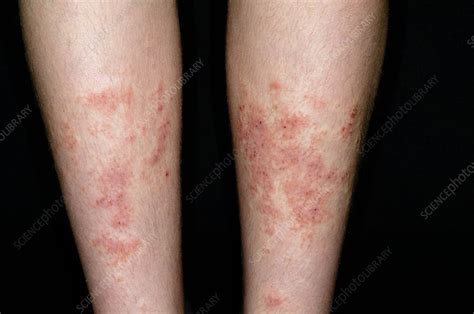 Allergic Skin Reaction To Shin Pads Stock Image C0142675 Science