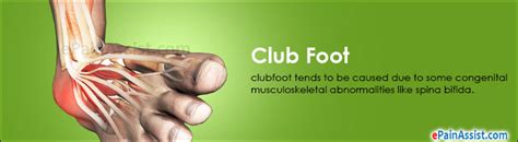 With proper treatment the majority of club foot can't be treated before birth, but picking up the problem during pregnancy means you can. Clubfoot: Treatment, Causes, Symptoms, Diagnosis