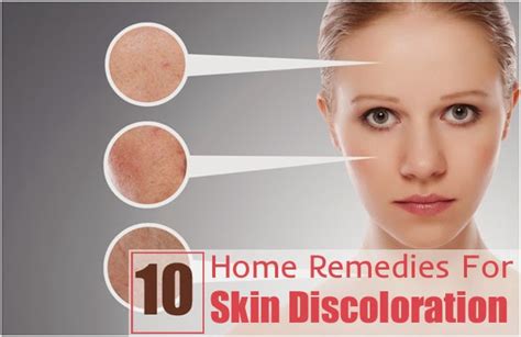 Top 10 Effective Home Remedies For Skin Discoloration ~ Mzizi Mkavu