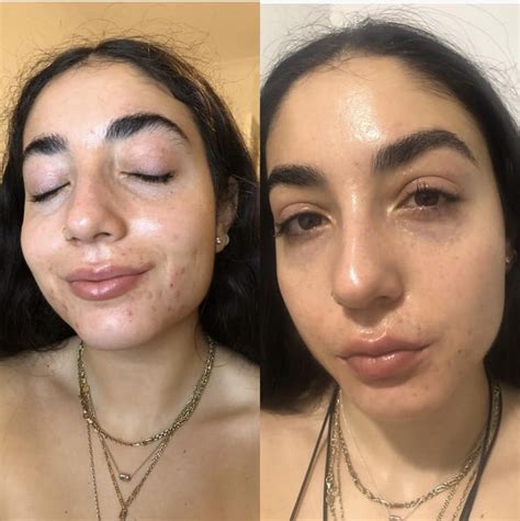 How To Keep Acne Skin Hydrated On Accutane Popsugar Beauty