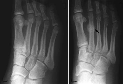 Stress Fractures Of The Foot And Ankle Orthoinfo Aaos