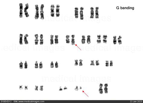 Stock Image Karyotype Of A Female Patient With Chronic Myeloid Leukemia Cml G Banding Showing A