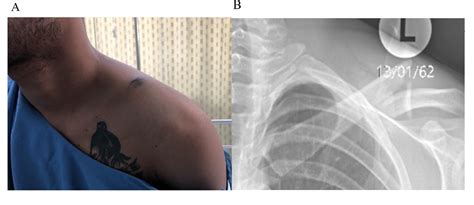 Figure 1 From Wide Awake Local Anesthesia For Clavicle Fracture