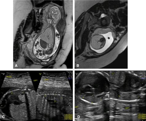 Mainstem Bronchial Atresia A Lethal Anomaly Amenable To Fetal Surgical