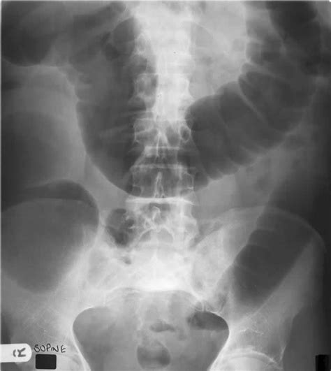 Large Bowel Obstruction The Clinical Advisor