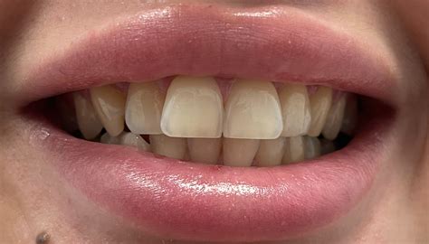 Teeth Contouring And Teeth Reshaping Swish Dental Brisbane