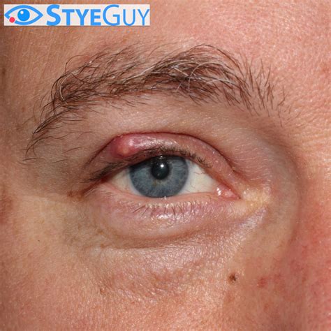 Upper Eyelid Stye Styeguy