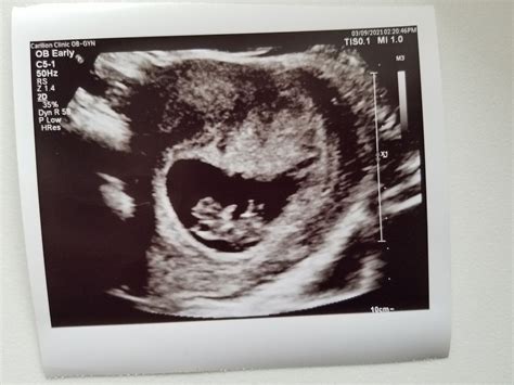 8 9 Week Ultrasounds Babycenter