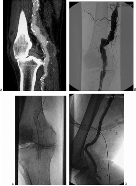Popliteal Artery Aneurysm Treatment With A Covered Stent A 75 Year Old