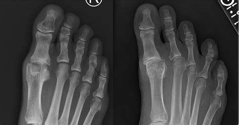 Arthritis Great Toe Hallux Rigidus — Chicago Foot And Ankle Orthopaedic