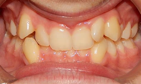 Braces For Severely Crowded Teeth No Teeth Extracted Platinum