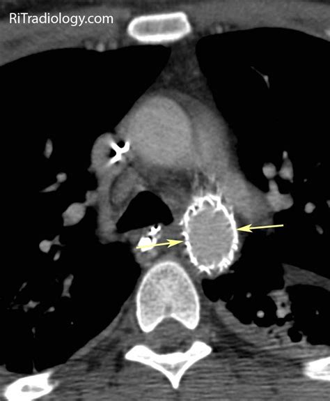 Rit Radiology Post Endovascular Rx Of Thoracic Aortic Injury