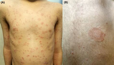 Covid‐19 Associated Pityriasis Rosea‐like Eruptions Several