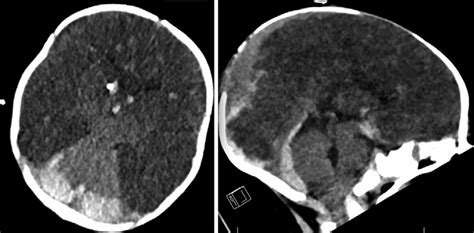 Axial Left And Sagittal Right Ct Scans Without Contrast