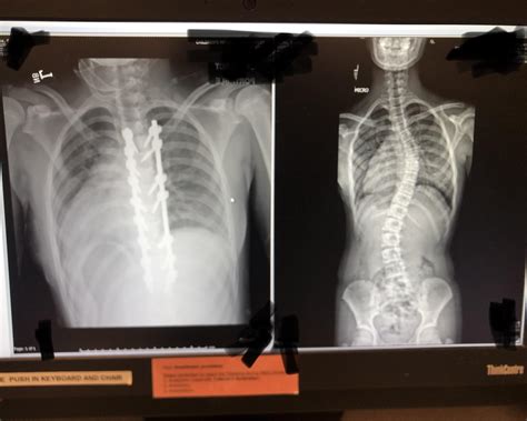 My Daughter 11 Scoliosis Surgery Today Was A Success Scariest Six