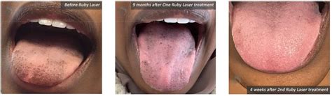 Black Spots On Tongue And Pigmentation In Nyc Ruby Laser Resurfacing