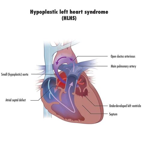 104 Best Images About Dustins Hlhs Hypoplstic Left Heart Syndrome On