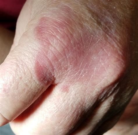 Fungal Skin Infection Hands