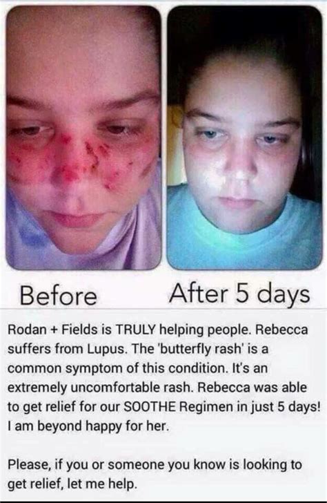 Acne Rosacea Vs Lupus Rash Lupus Misdiagnosis Diseases That Can Mimic