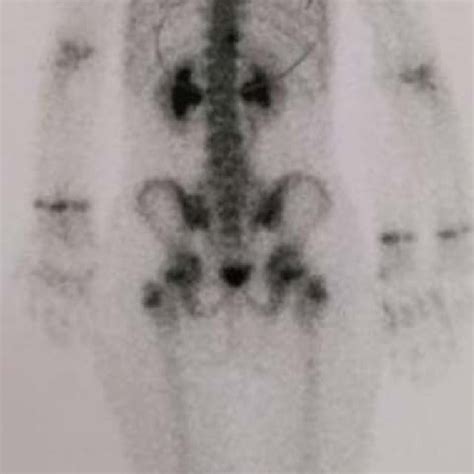 Bone Scintigraphy The Image Shows A Slight Increase In Osteoblastic