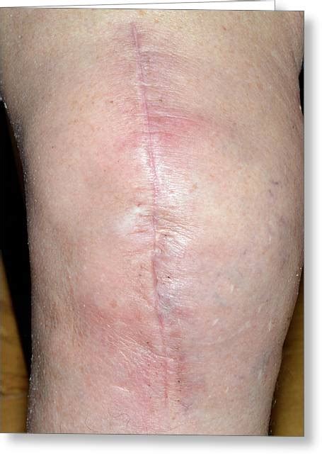 Two peroneal flaps were performed before tka to replace previous traumatic scar formed around the knee. Infected Total Knee Replacement Wound Photograph by Dr P ...