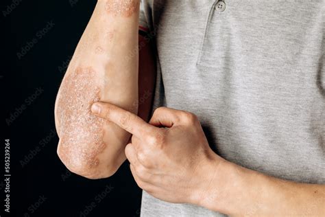 Acute Psoriasis On The Elbows Is An Autoimmune Incurable Dermatological