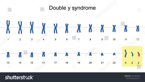 Double Y Syndrome Karyotype Nondisjunction Sex เวกเตอร์สต็อก ปลอดค่าลิขสิทธิ์ 1427362847