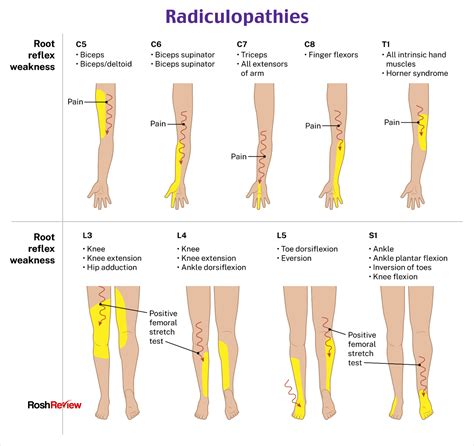 Radiculopathies In Physical Therapy Assistant Physical Therapy