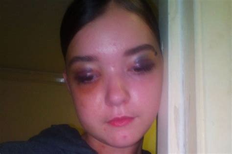 Shocking Pictures Show Teenage Girl Bloodied And Bruised After She Was