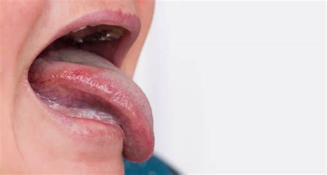 Oral Lichen Planus Guide Dentist Ahmed Official Website