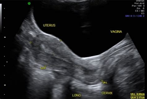 Identification Of The Uterine Position Sagittal View From Ta