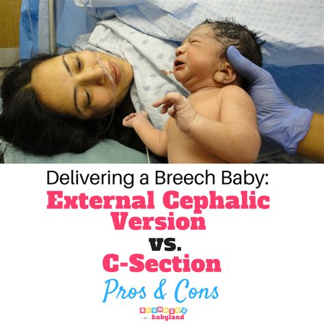 External Cephalic Version Vs A C Section Pros And Cons Which Procedure