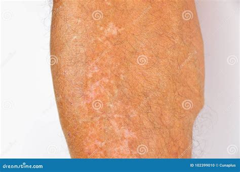 Pigmentation On Legs Stock Photo Image Of Medicine 102399010