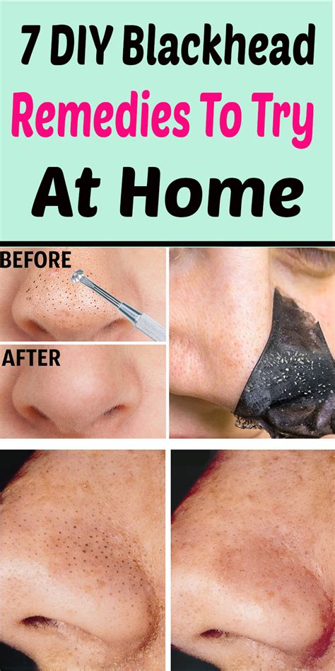How To Get Rid Of Blackheads Quickly At Home Howtoremvo