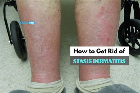 How To Get Rid Of Stasis Dermatitis In 5 Ways That Work