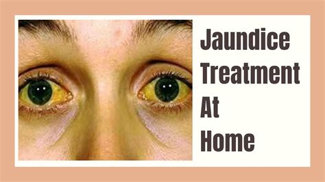 Jaundice Treatment At Home How To Cure Jaundice Jaundice Treatment