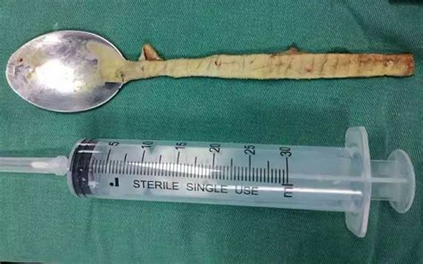 Doctors Retrieve Spoon From Mans Esophagus — A Year After He Swallowed It Live Science