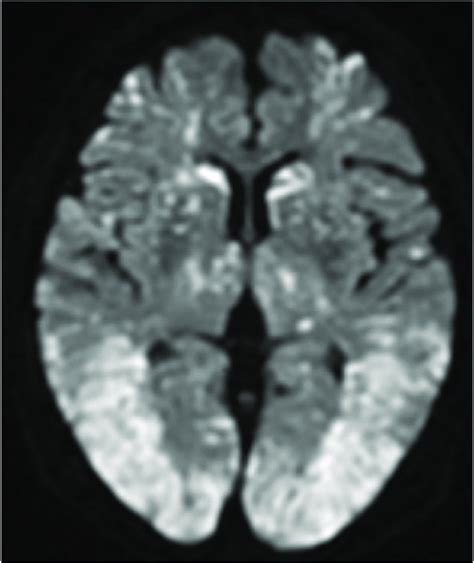 Follow Up Brain Magnetic Resonance Imaging Diffusion Weighted Imaging