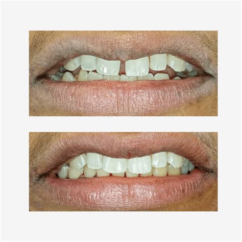 Midline Diastema Closure With Composite Layering Technique The