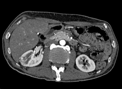 Small Angiomyolipoma Aml Of The Right Kidney Kidney Case Studies